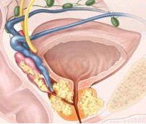 前列腺痛的癥狀