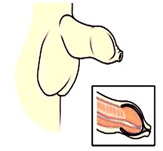 包皮過長的危害