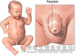 男人包皮過長怎么辦才好呢